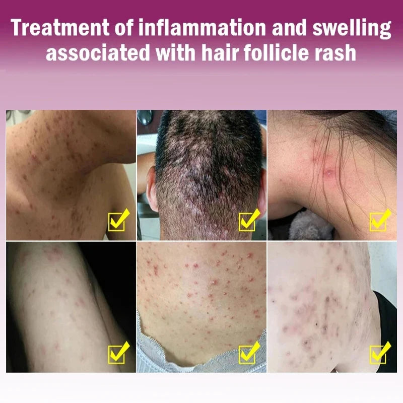 Anti-itching Care Herbal Cream