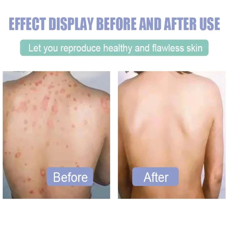 Anti-itching Care Herbal Cream